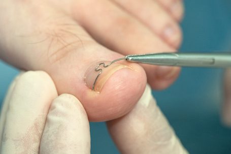 Behandlung eines eingewachsenen Zehennagels mit Nagelspange